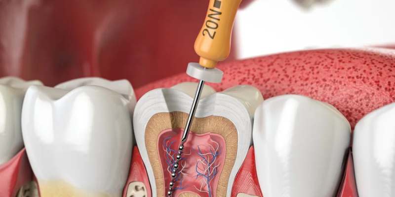 Single Sitting RCT Davanagere for quick tooth pain relief