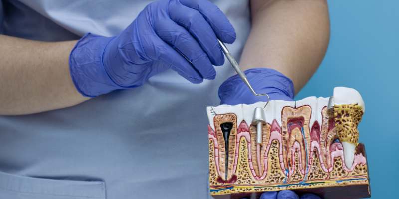 Single Sitting RCT Davanagere for effective tooth pain treatment