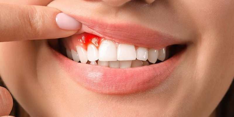Bleeding Gums Treatment
