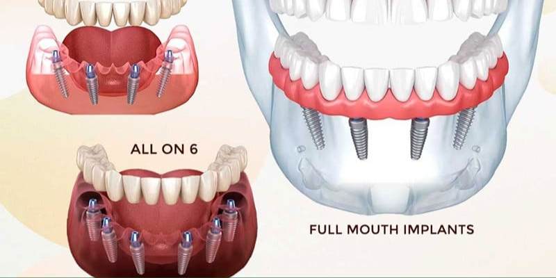 Full Mouth Implants Davanagere for complete smile restoration
