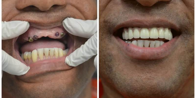 Dental Implants Davanagere before and after full mouth rehabilitation